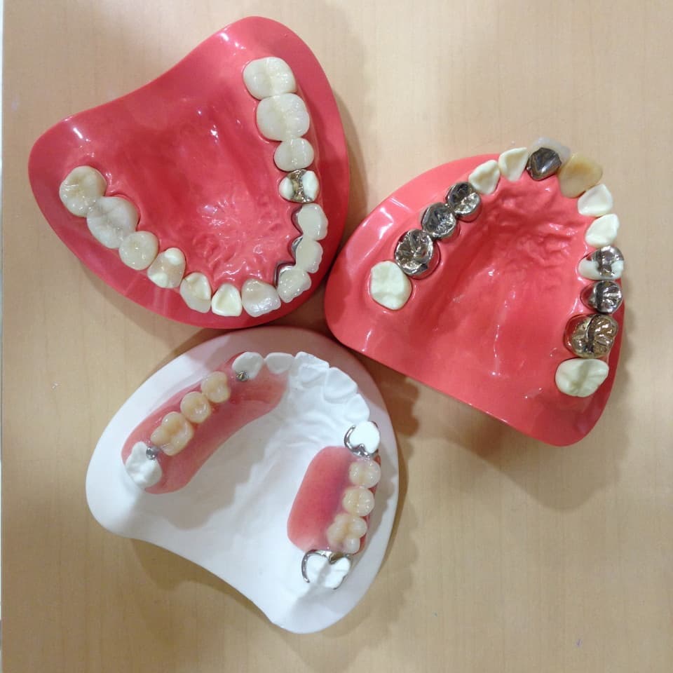 西東京市ナチュラル歯科の補綴模型