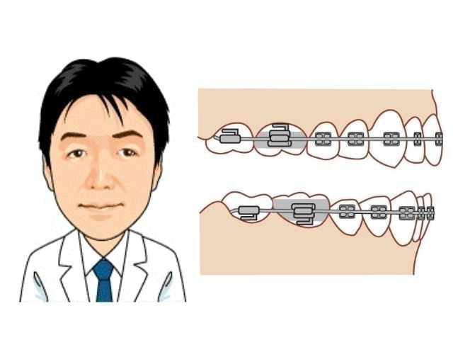 西東京市ナチュラル歯科の矯正イラスト